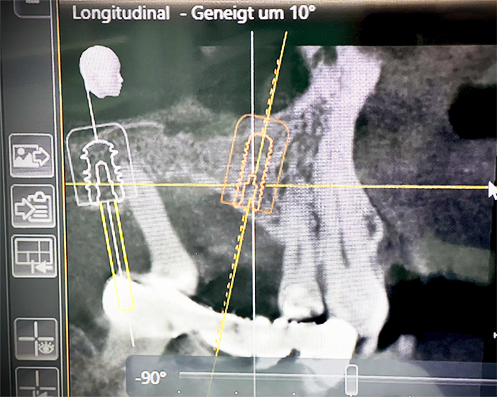 BLX Implanationsplanung